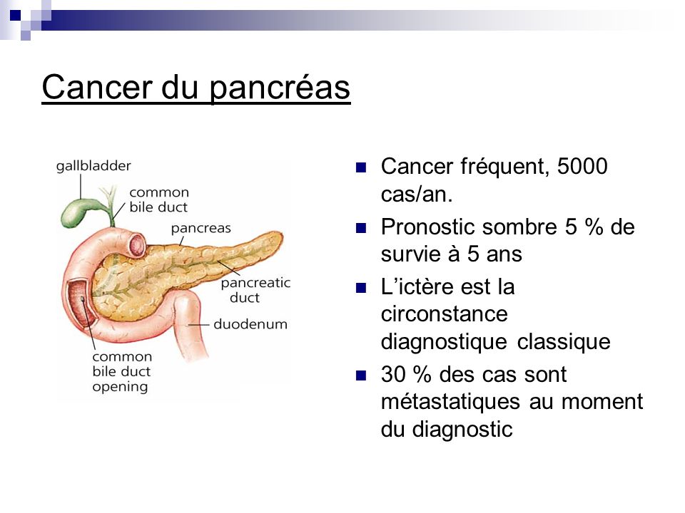 tumeur du pancreas