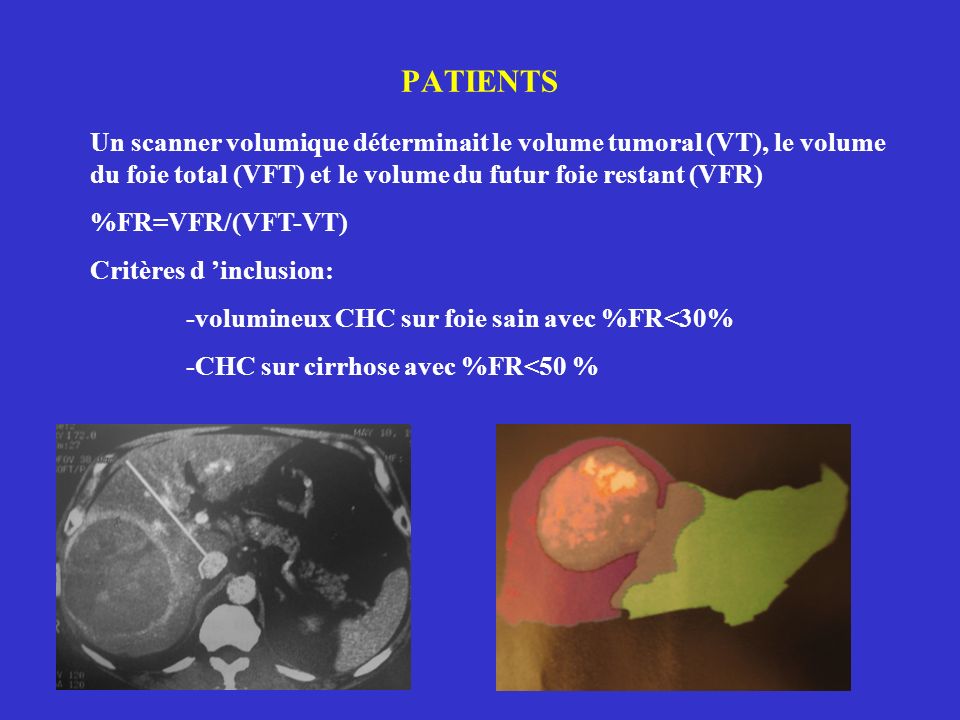 PATIENTS Un scanner volumique déterminait le volume tumoral (VT), le volume du foie total (VFT) et le volume du futur foie restant (VFR) %FR=VFR/(VFT-VT) Critères d inclusion: -volumineux CHC sur foie sain avec %FR<30% -CHC sur cirrhose avec %FR<50 %