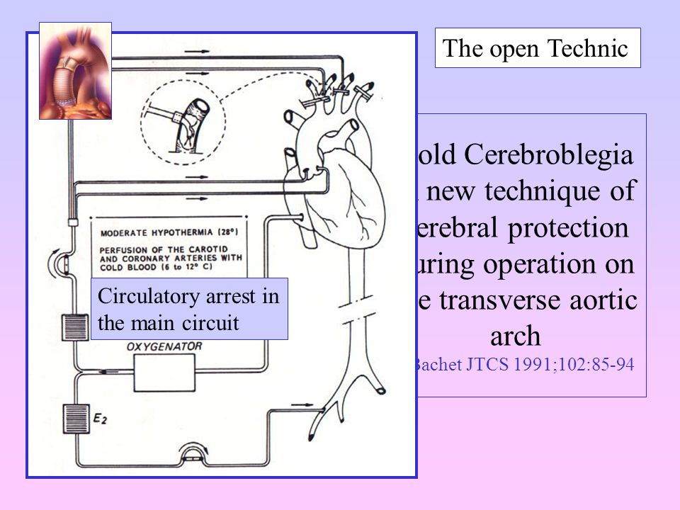 Cold Cerebroblegia A new technique of cerebral protection during operation on the transverse aortic arch J Bachet JTCS 1991;102:85-94 The open Technic Circulatory arrest in the main circuit
