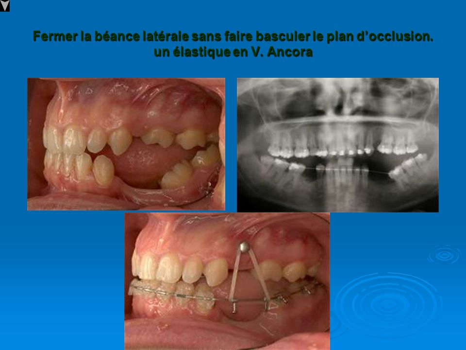 Anchorage In Orthodontics Ppt