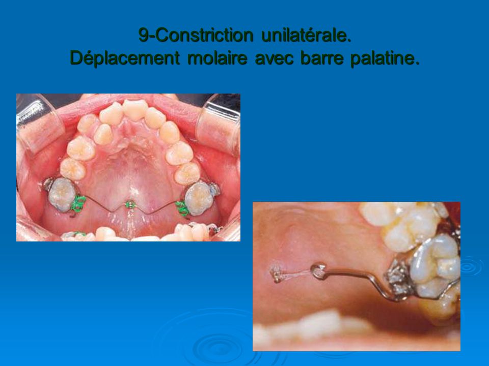 Anchorage In Orthodontics Ppt