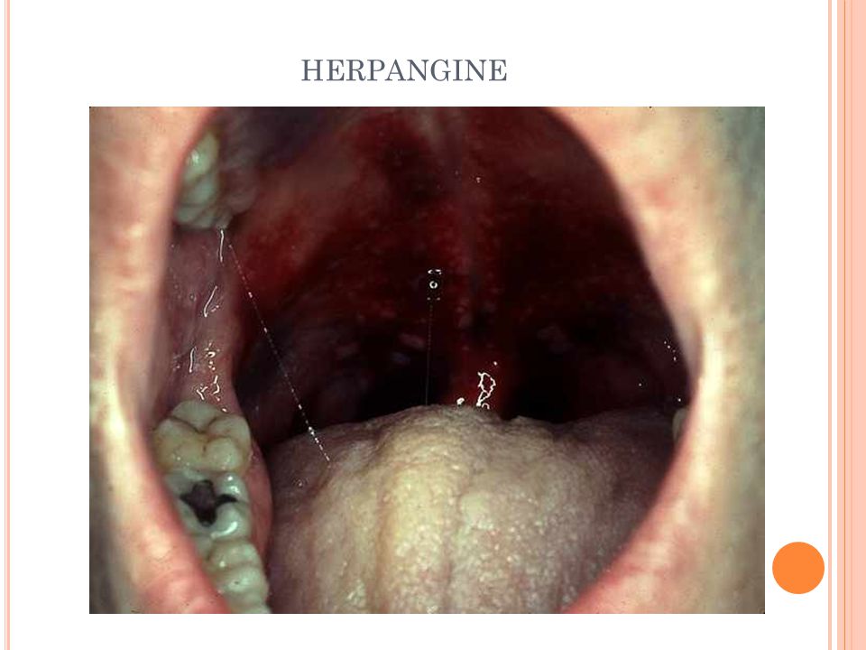 rencontre herpes