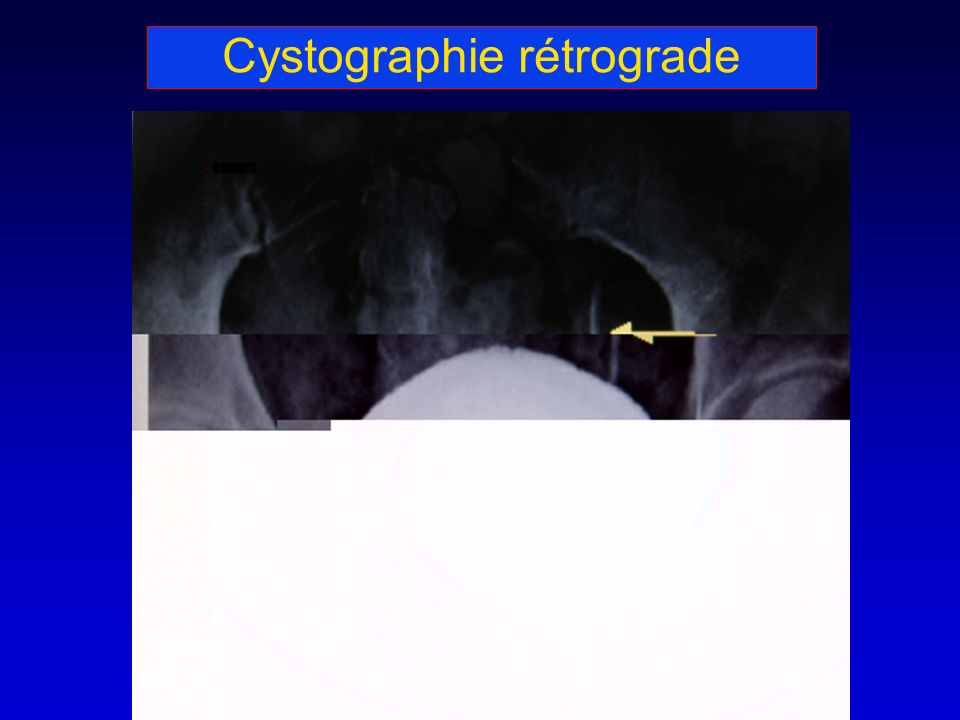 Cystographie rétrograde
