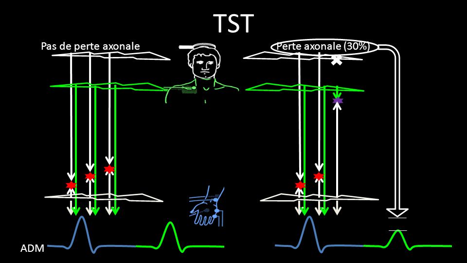TST ADM Pas de perte axonale Perte axonale (30%)