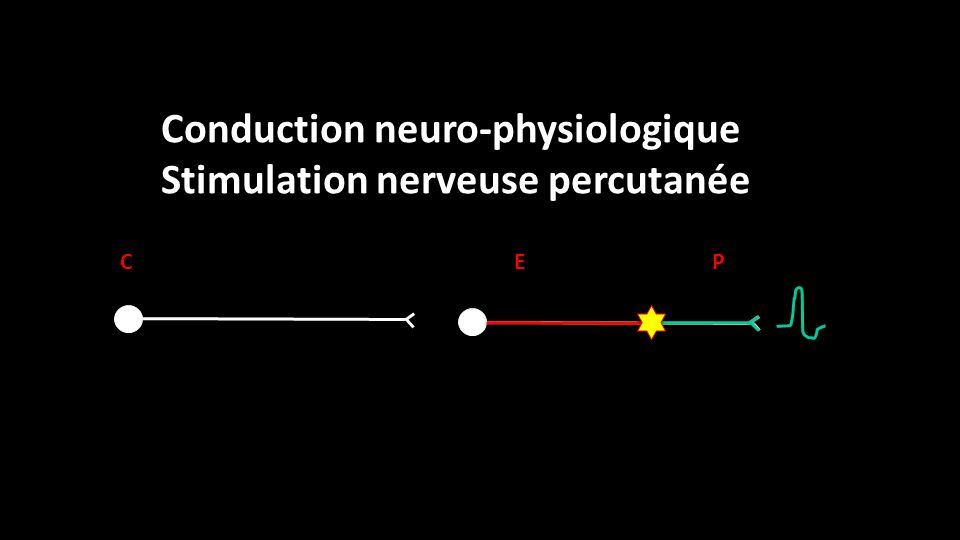 P E C Conduction neuro-physiologique Stimulation nerveuse percutanée
