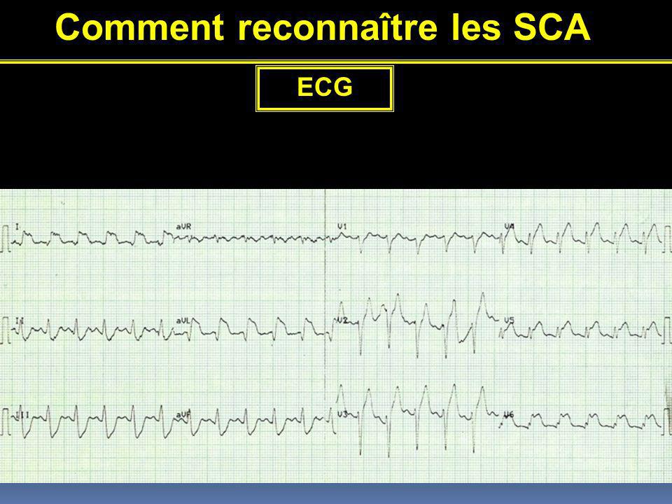 Comment reconnaître les SCA ECG