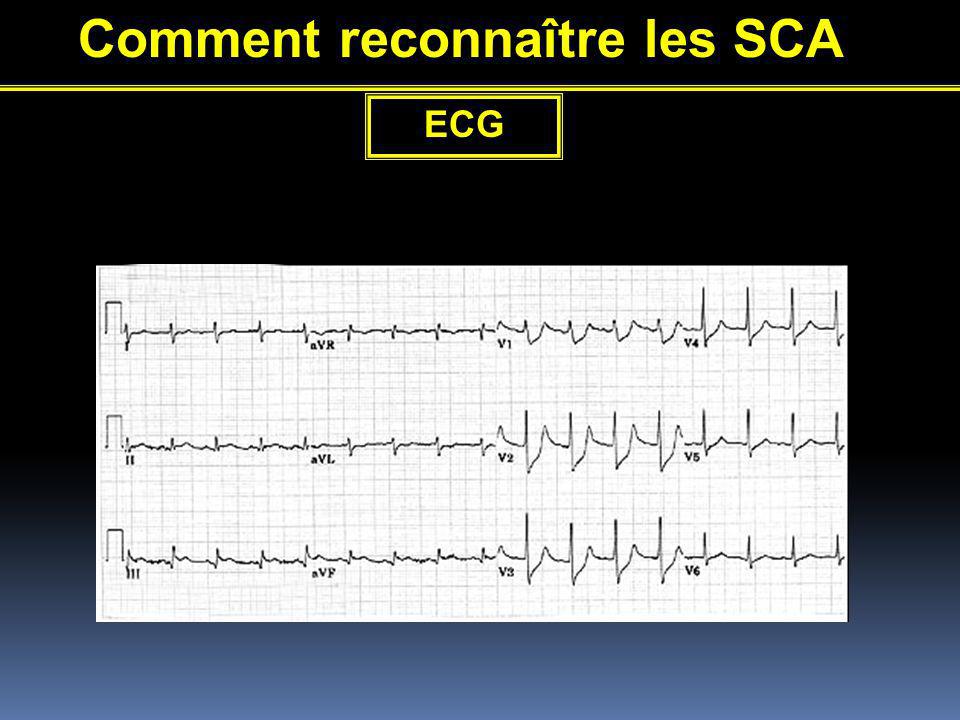 Comment reconnaître les SCA ECG