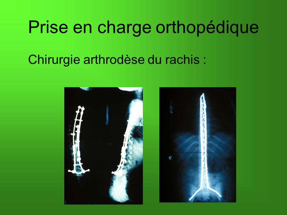 Prise en charge orthopédique Chirurgie arthrodèse du rachis :