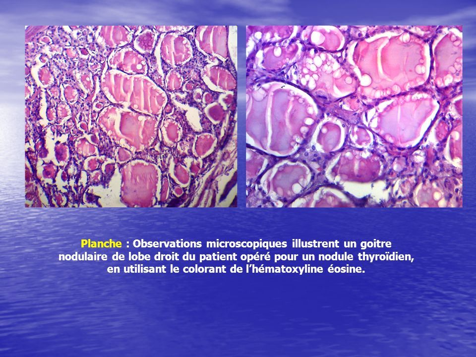 Planche : Observations microscopiques illustrent un goitre nodulaire de lobe droit du patient opéré pour un nodule thyroïdien, en utilisant le colorant de l’hématoxyline éosine.