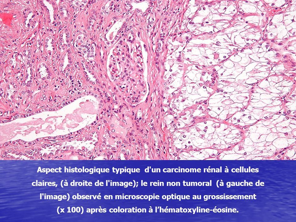 Aspect histologique typique d un carcinome rénal à cellules claires, (à droite de l image); le rein non tumoral (à gauche de l image) observé en microscopie optique au grossissement (x 100) après coloration à l’hématoxyline-éosine.