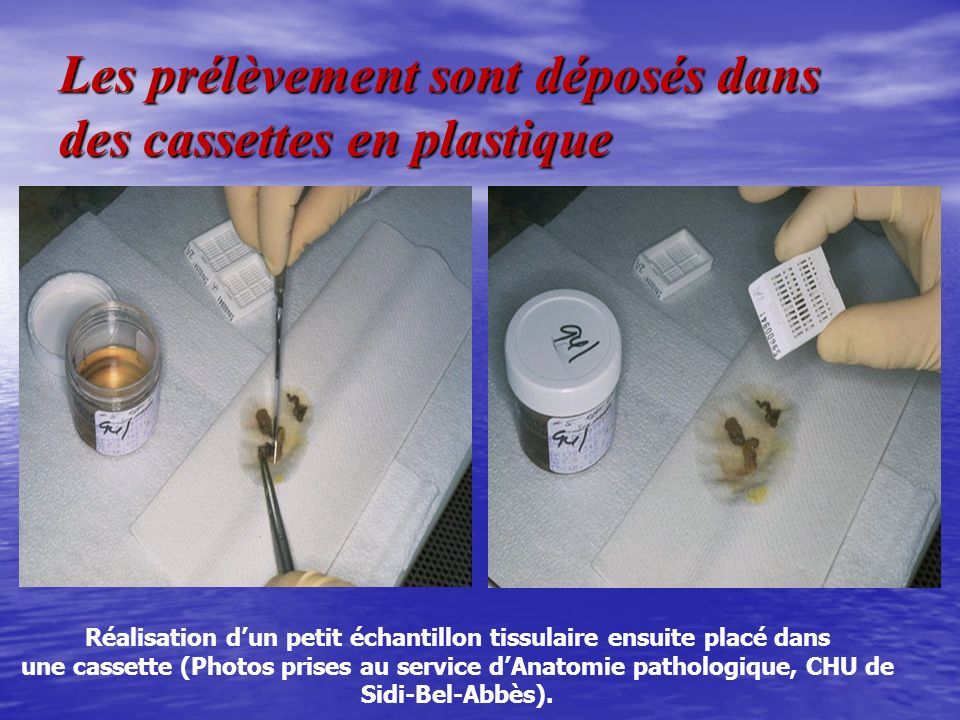 Les prélèvement sont déposés dans des cassettes en plastique Réalisation d’un petit échantillon tissulaire ensuite placé dans une cassette (Photos prises au service d’Anatomie pathologique, CHU de Sidi-Bel-Abbès).