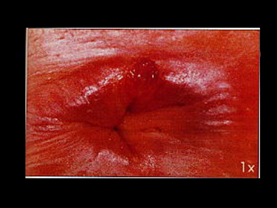 La fissure anale est une déchirure, une crevasse ou une lésion de la paroi du canal.