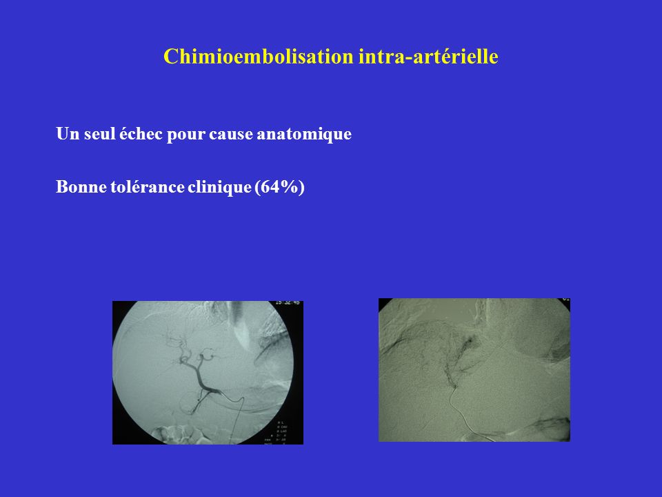 Chimioembolisation intra-artérielle Un seul échec pour cause anatomique Bonne tolérance clinique (64%)