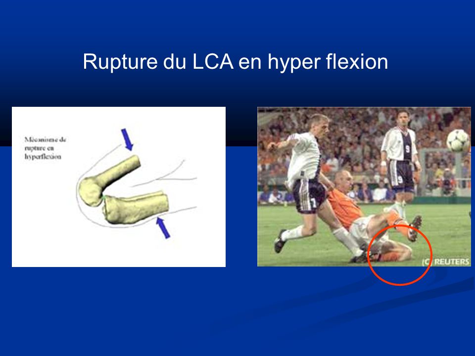 Rupture du LCA en hyper flexion