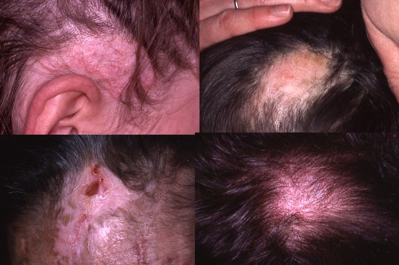 Manifestations dermatologiques du lupus - ppt video online télécharger