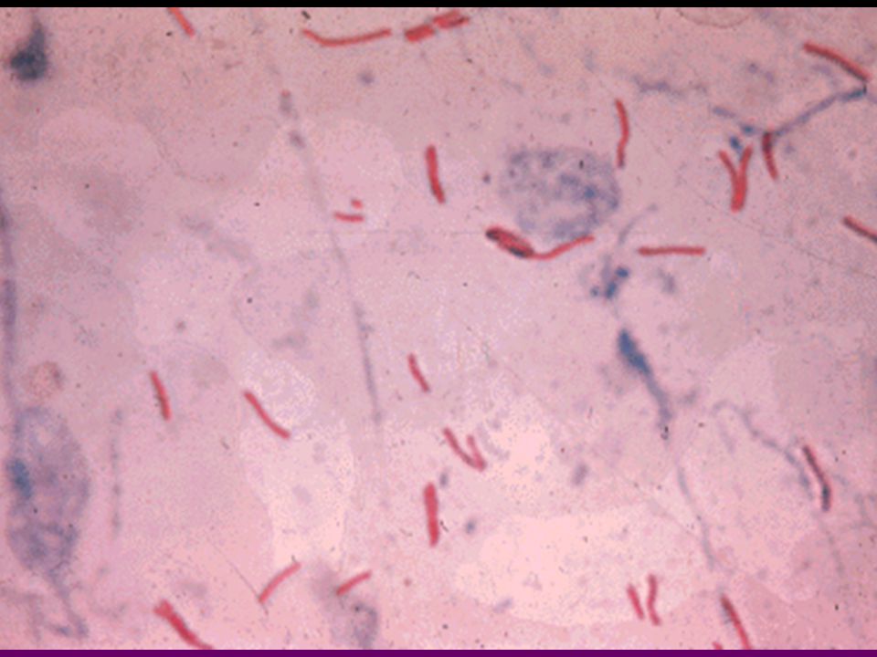 Новый вирус туберкулеза. Палочка Коха микроскопия. Палочки – микобактерия туберкулеза. Палочка Коха микрофотография. Микобактерии туберкулеза микробиология.