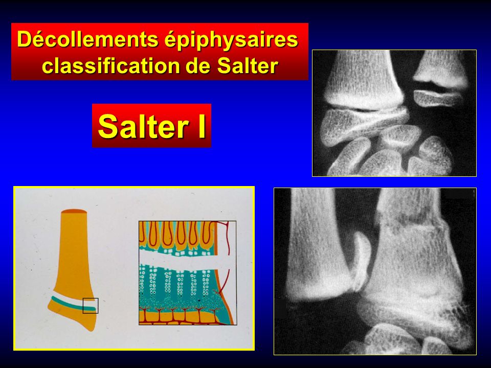 Salter I Décollements épiphysaires classification de Salter