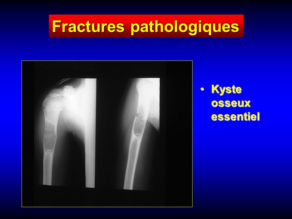 Kyste osseux essentielKyste osseux essentiel Fractures pathologiques