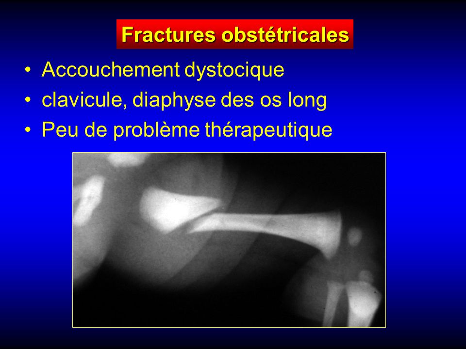 Fractures obstétricales Accouchement dystocique clavicule, diaphyse des os long Peu de problème thérapeutique
