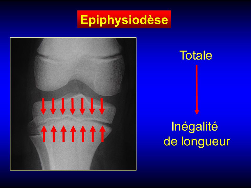 Epiphysiodèse Totale Inégalité de longueur