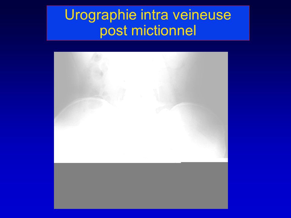 Urographie intra veineuse post mictionnel