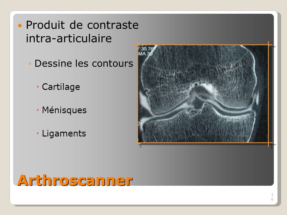 16 Arthroscanner 16 Produit de contraste intra-articulaire Dessine les contours Cartilage Ménisques Ligaments