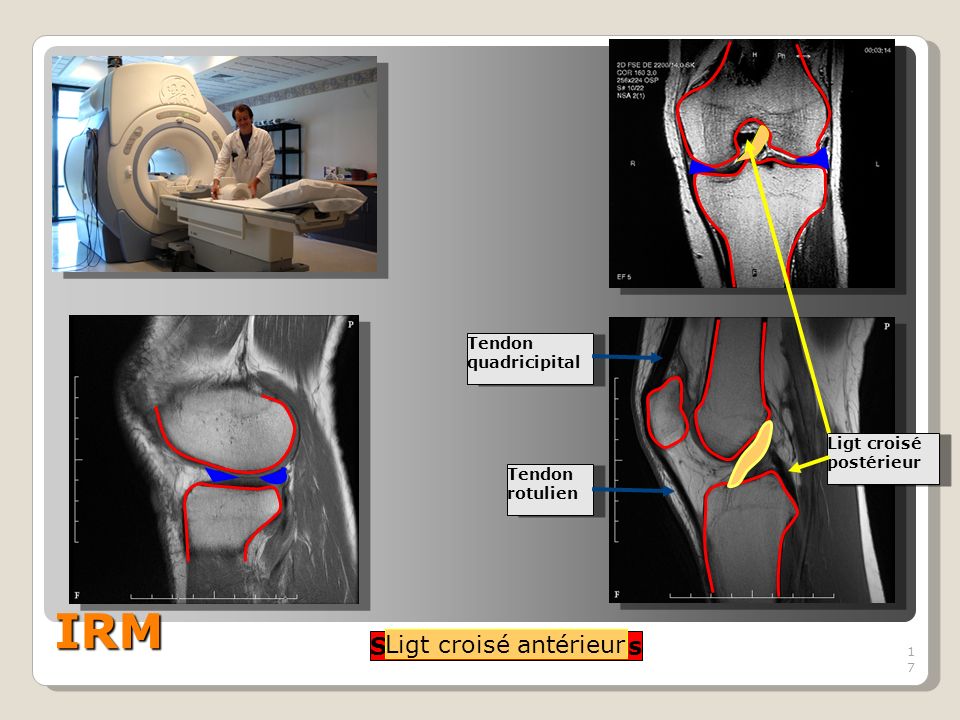 17 IRM 17 Structures osseuses Ménisques Ligt croisé antérieur Ligt croisé postérieur Tendon rotulien Tendon quadricipital