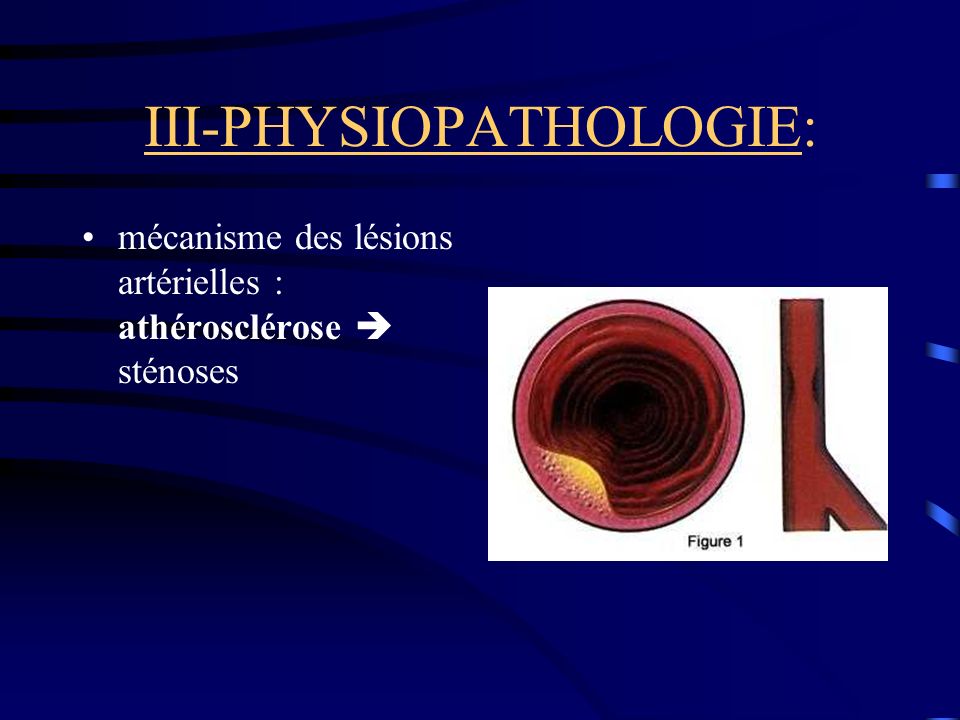 III-PHYSIOPATHOLOGIE: mécanisme des lésions artérielles : athérosclérose sténoses