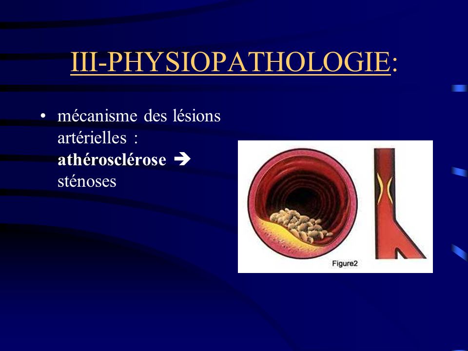 III-PHYSIOPATHOLOGIE: mécanisme des lésions artérielles : athérosclérose sténoses