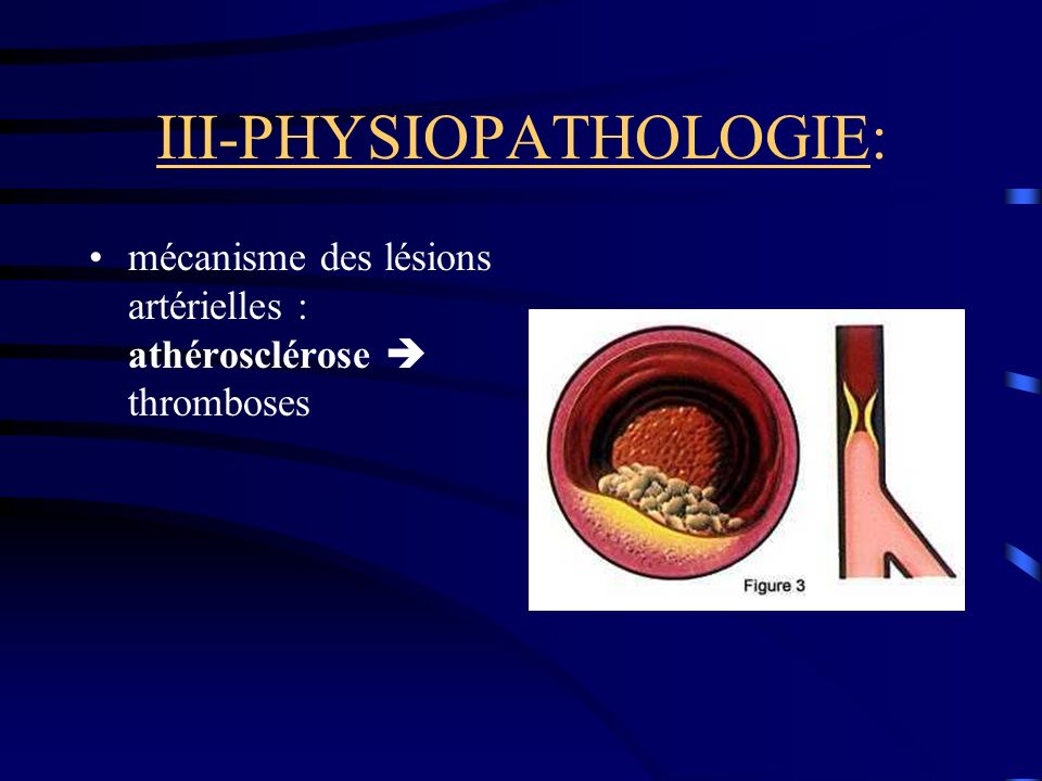 III-PHYSIOPATHOLOGIE: mécanisme des lésions artérielles : athérosclérose thromboses