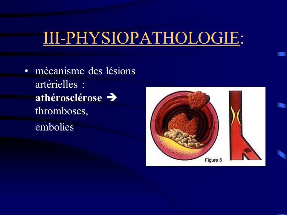 III-PHYSIOPATHOLOGIE: mécanisme des lésions artérielles : athérosclérose thromboses, embolies