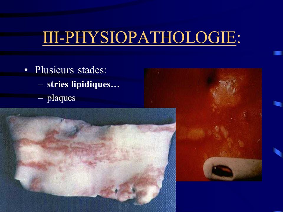 III-PHYSIOPATHOLOGIE: Plusieurs stades: –stries lipidiques… –plaques