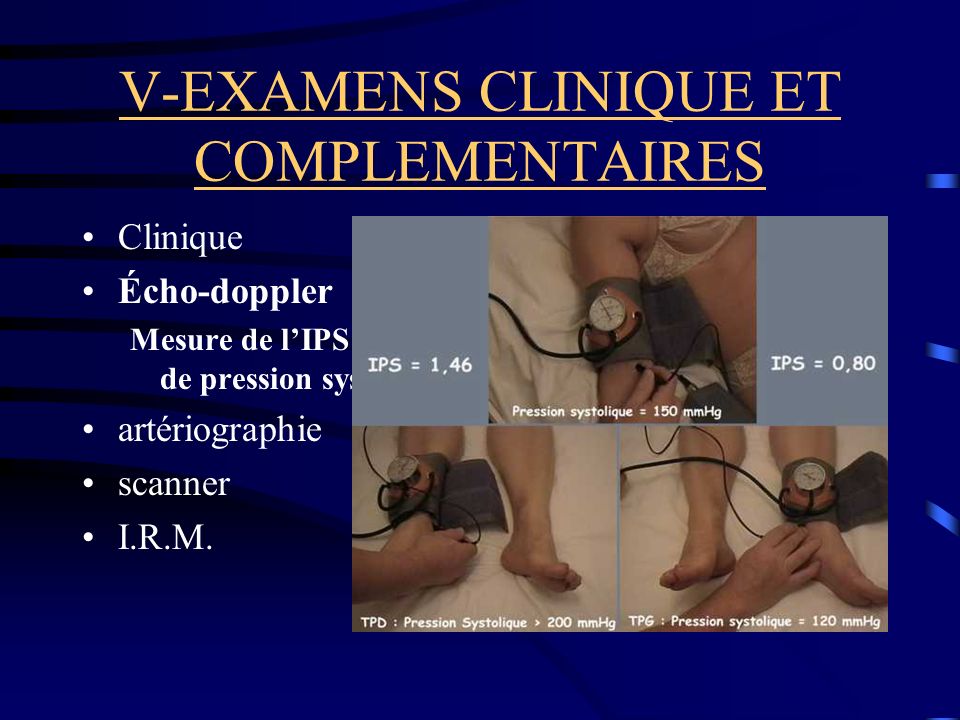 V-EXAMENS CLINIQUE ET COMPLEMENTAIRES Clinique Écho-doppler Mesure de lIPS -index de pression systolique artériographie scanner I.R.M.