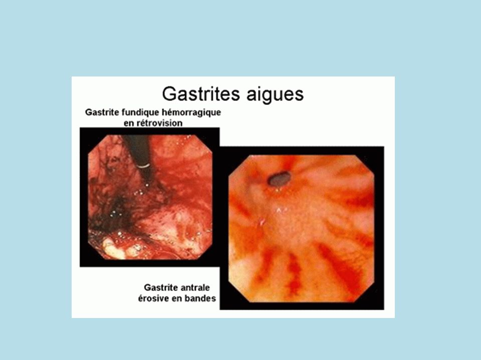 Gastrites Aigues ou chroniques. - ppt video online télécharger