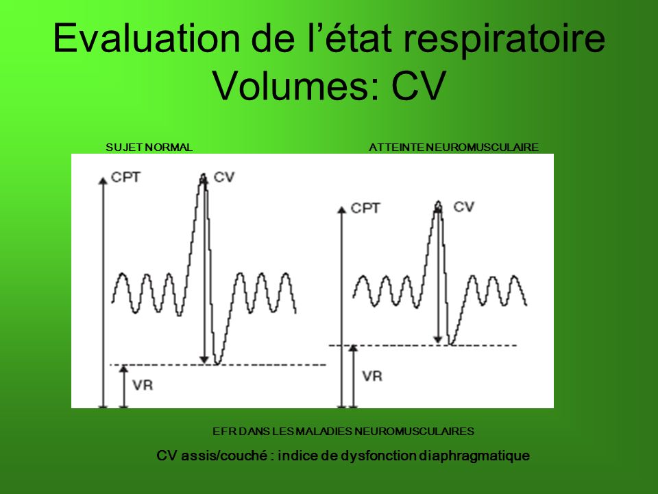 Evaluation de létat respiratoire Volumes: CV EFR DANS LES MALADIES NEUROMUSCULAIRES CV assis/couché : indice de dysfonction diaphragmatique SUJET NORMALATTEINTE NEUROMUSCULAIRE