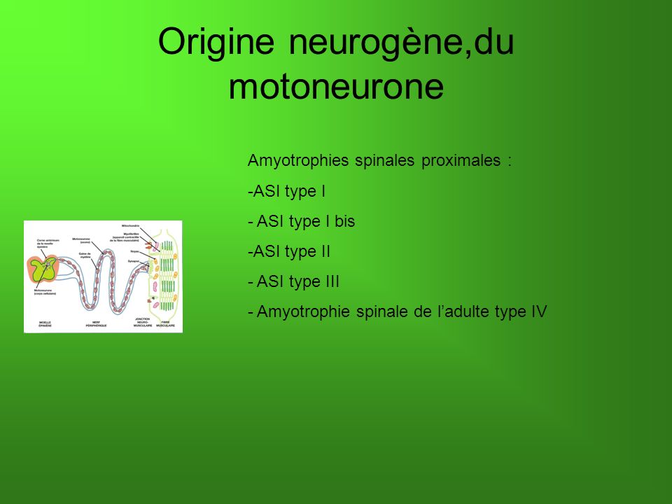 Origine neurogène,du motoneurone Amyotrophies spinales proximales : -ASI type I - ASI type I bis -ASI type II - ASI type III - Amyotrophie spinale de ladulte type IV