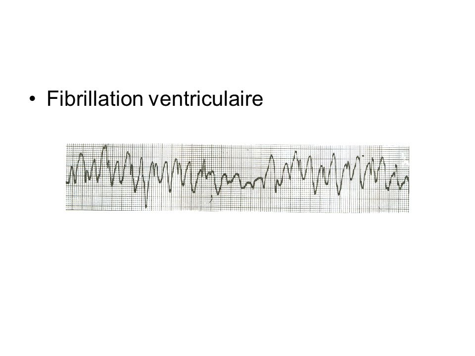 Fibrillation ventriculaire
