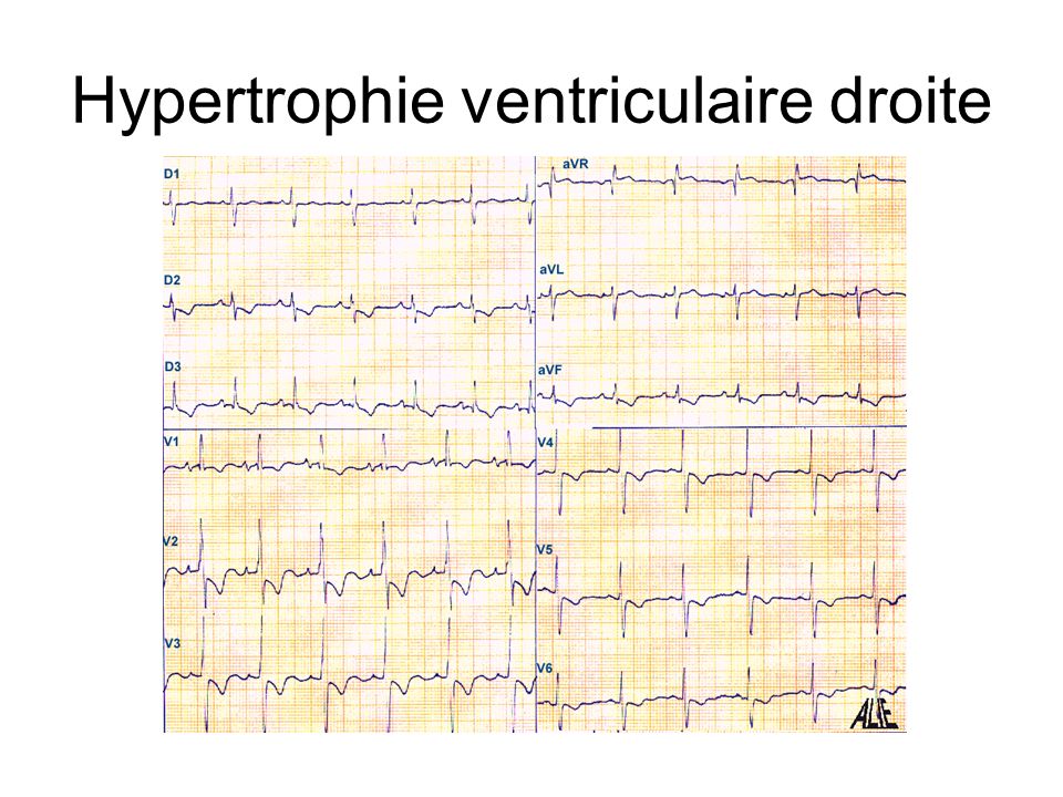 Hypertrophie ventriculaire droite