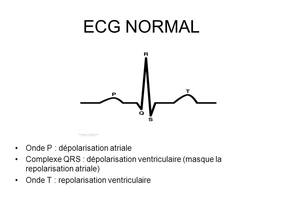 ECG NORMAL Onde P : dépolarisation atriale Complexe QRS : dépolarisation ventriculaire (masque la repolarisation atriale) Onde T : repolarisation ventriculaire
