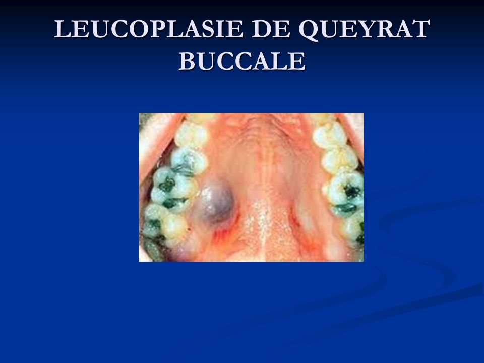 LEUCOPLASIE DE QUEYRAT BUCCALE