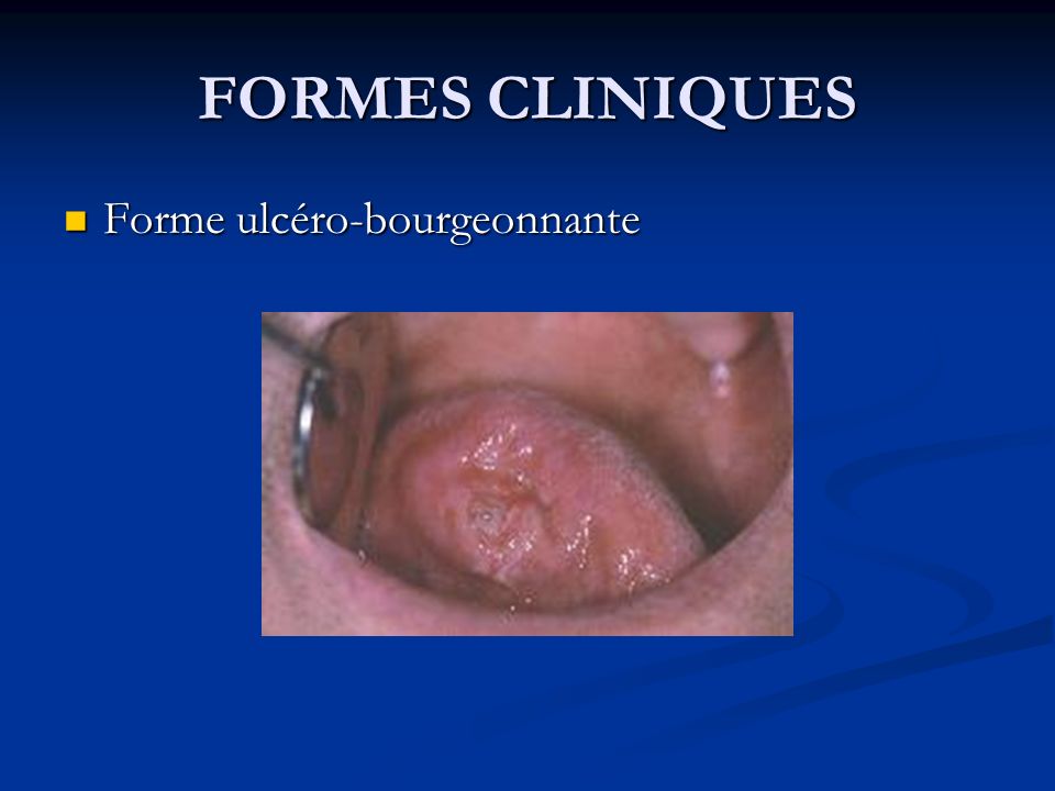 FORMES CLINIQUES Forme ulcéro-bourgeonnante Forme ulcéro-bourgeonnante