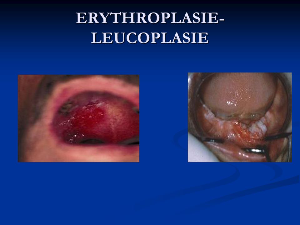 ERYTHROPLASIE- LEUCOPLASIE