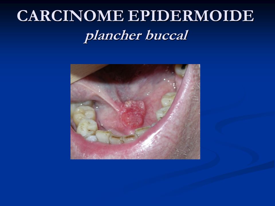 CARCINOME EPIDERMOIDE plancher buccal