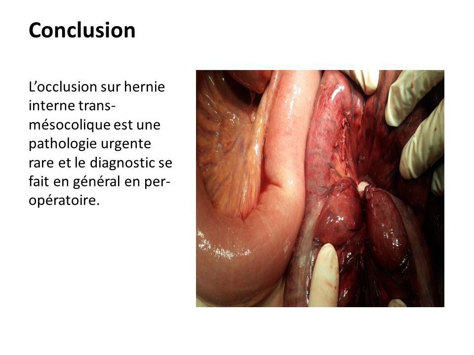 Conclusion L’occlusion sur hernie interne trans- mésocolique est une pathologie urgente rare et le diagnostic se fait en général en per- opératoire.