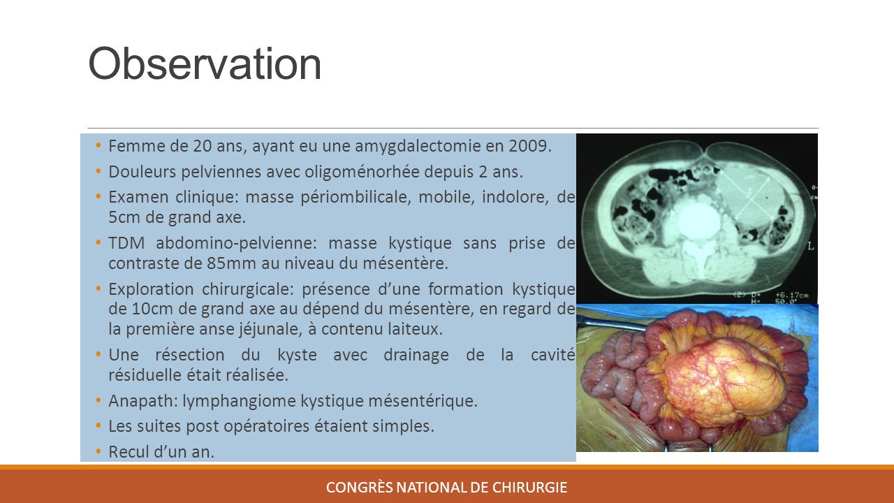 Observation CONGRÈS NATIONAL DE CHIRURGIE Femme de 20 ans, ayant eu une amygdalectomie en 2009.