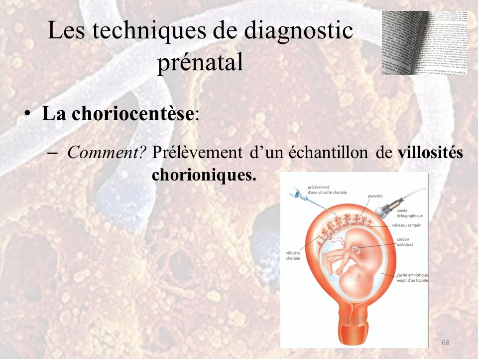Les techniques de diagnostic prénatal La choriocentèse: – Comment.