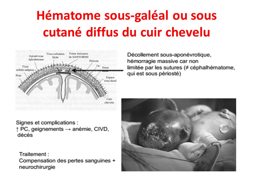 Extractions Insturmentales Par Forceps Et Spatules Et Ventouse Universite Sainte Famille Faculte De Sante Usf Dr Fouad Gerges Ppt Telecharger