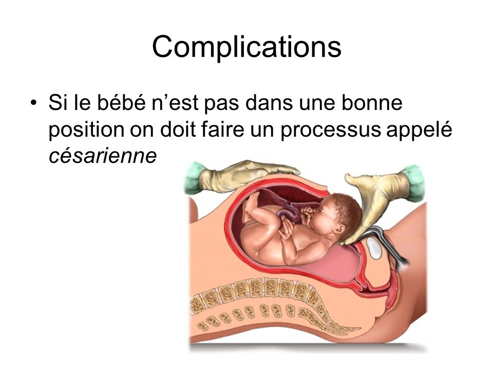 Complications Si le bébé n’est pas dans une bonne position on doit faire un processus appelé césarienne