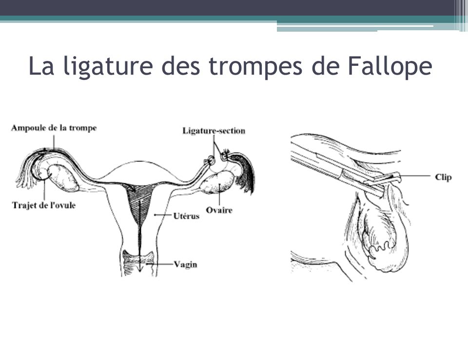 La ligature des trompes de Fallope