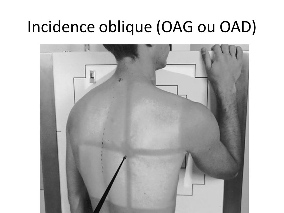 Incidence oblique (OAG ou OAD)